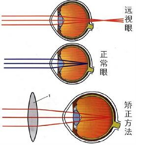 什么是远视眼？