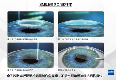 全飞秒激光和传统飞秒激光手术的优缺点有哪些？