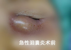 谁懂啊！急性泪囊炎遭大罪，*还不疼！