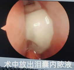 谁懂啊！急性泪囊炎遭大罪，*还不疼！