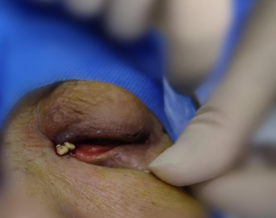 流泪流脓1年治不好？这种复杂泪道病，别再盲目滴眼药水了