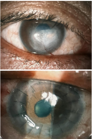 角膜传大爱，生命续华章，致敬无私奉献的角膜捐献者